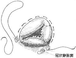 三尖瓣关闭不全